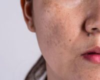 manchas-piel-serum-intense-kaare-skin-cosmetics-03